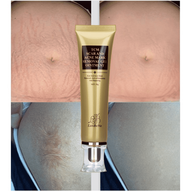 Acne Scar Stretch Marks Remover Whitening Facial Self Tanners Cream Facial Self Tanners & Bronzers LoveUrBeauty Store