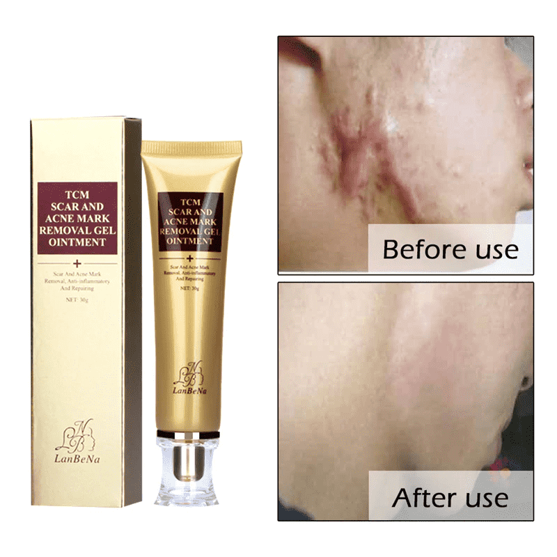Acne Scar Stretch Marks Remover Whitening Facial Self Tanners Cream Facial Self Tanners & Bronzers LoveUrBeauty Store
