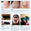 Acne Treatment Pore Strip Blackhead Remover Treatments & Masks LANBENA Official Store