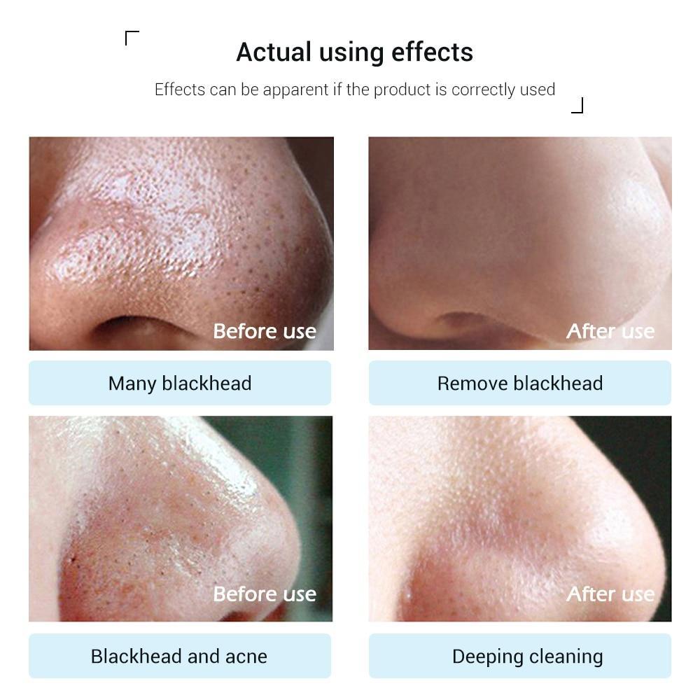 Acne Treatment Pore Strip Blackhead Remover Treatments & Masks LANBENA Official Store