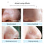 Acne Treatment Pore Strip Blackhead Remover Treatments & Masks LANBENA Official Store