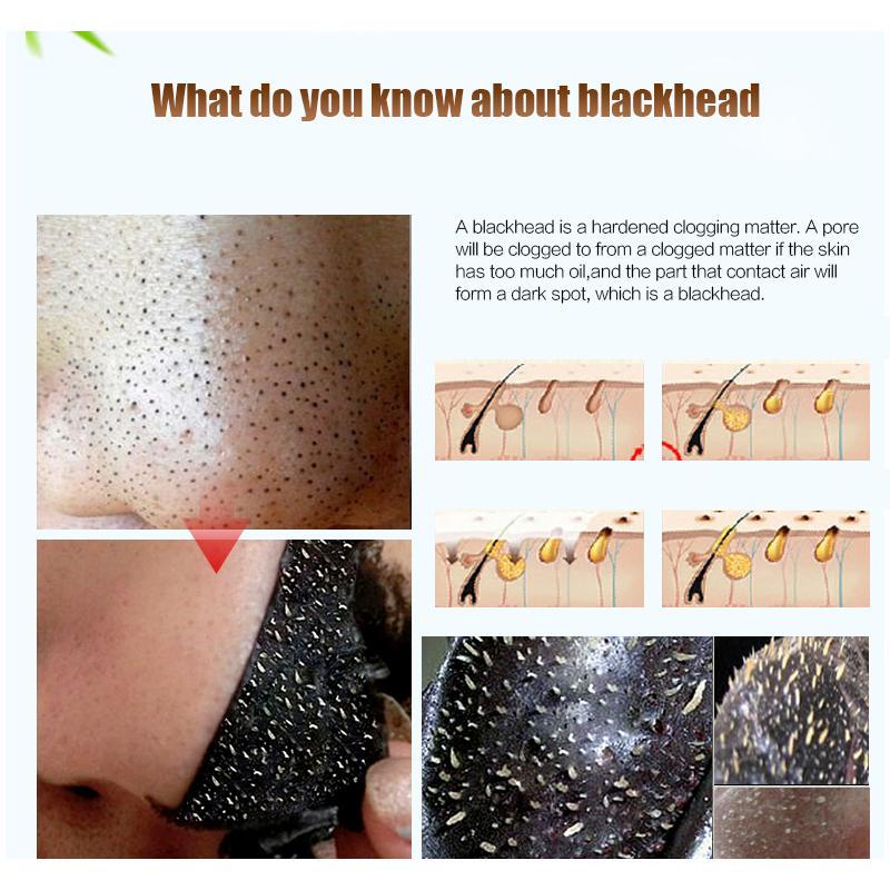 Blackhead Remover Peeling Patches Treatments & Masks The Beauty Outlet