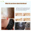 Blackhead Remover Peeling Patches Treatments & Masks The Beauty Outlet