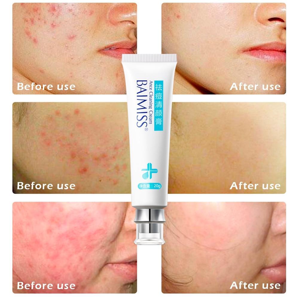Natural Herbal Scar Gel for Skin Serum BAIMISS Official Store