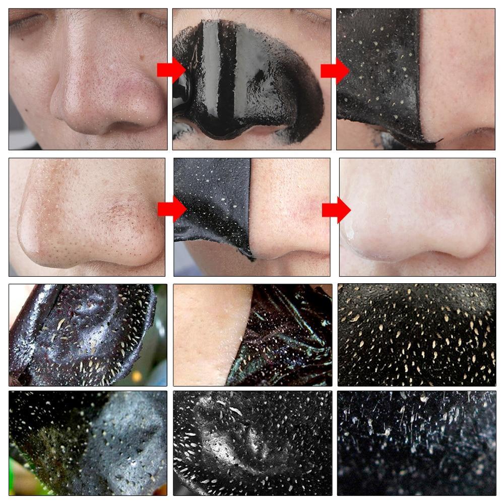 Nose Acne Treatment Peeling Mask Treatments & Masks LANBENA