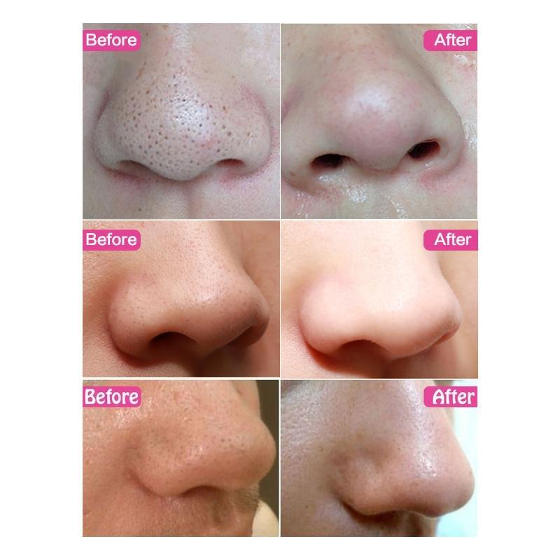 Nose Mask Shill for Acne Black Head Treatments & Masks SACE LADY Official Store