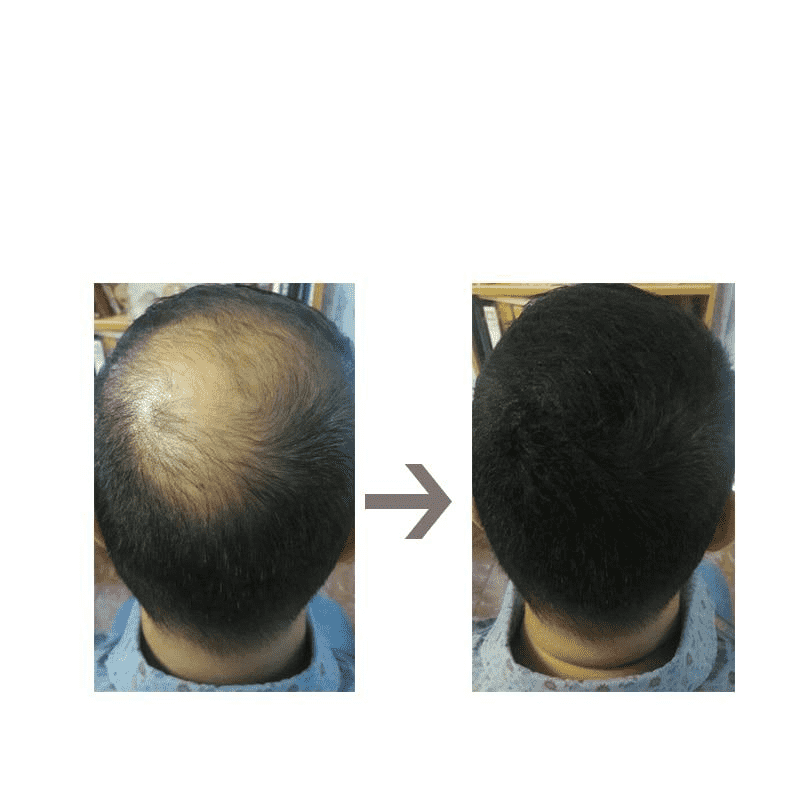 Thickener & Fiber Building Fuller Hair Loss Treatment Products for Men & Women Hair Loss Products S-Again Store