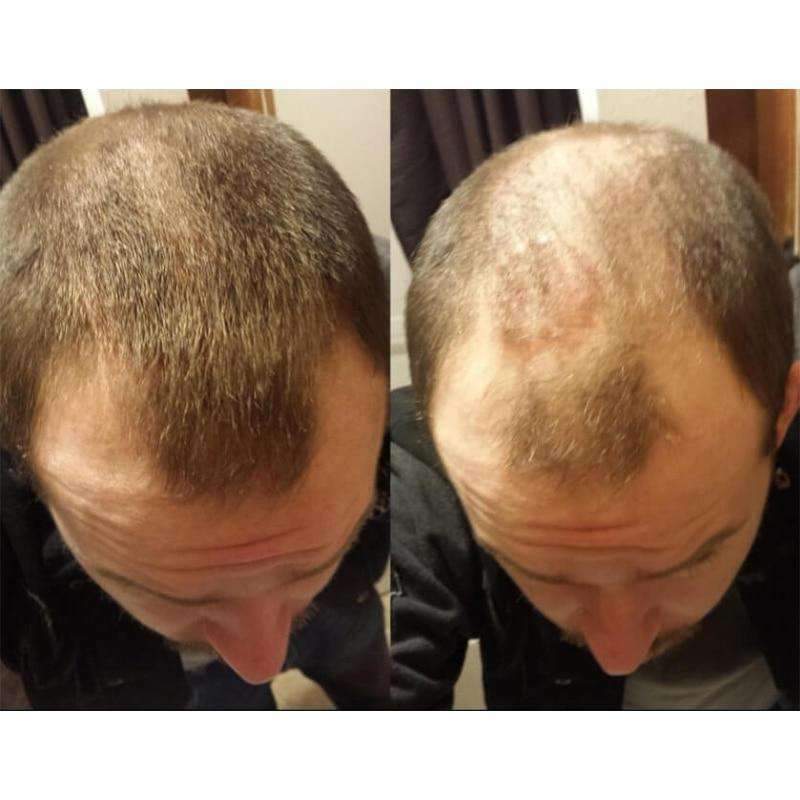Thickener & Fiber Building Fuller Hair Loss Treatment Products for Men & Women Hair Loss Products S-Again Store
