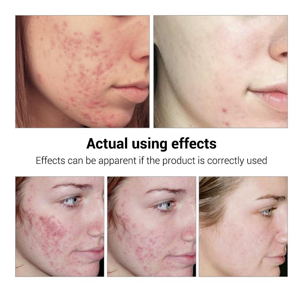 Whitening Repair Pimple Remover Cream Serum BREYLEE Official Store