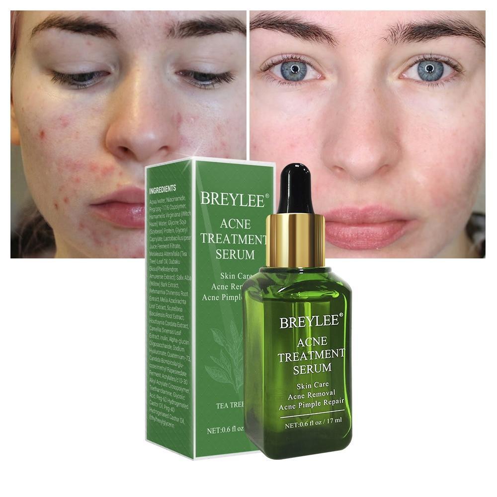 Whitening Repair Pimple Remover Cream Serum BREYLEE Official Store